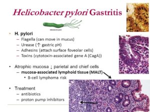 Gastritis treatment